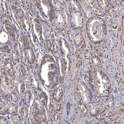 IHC staining of FFPE human prostate cancer tissue with TRMT2B antibody. HIER: boil tissue sections in pH8 EDTA for 20 min and allow to cool before testing.