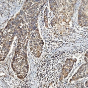 IHC staining of FFPE human larynx squamous cell carcinoma tissue with SELT antibody. HIER: boil tissue sections in pH8 EDTA for 20 min and allow to cool before testing.
