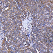 IHC staining of FFPE human ovarian serous cancer tissue with SELT antibody. HIER: boil tissue sections in pH8 EDTA for 20 min and allow to cool before testing.