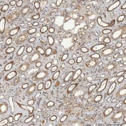 IHC staining of FFPE human renal cancer tissue with SELT antibody. HIER: boil tissue sections in pH8 EDTA for 20 min and allow to cool before testing.