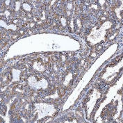 IHC staining of FFPE human thyroid cancer tissue with SELT antibody. HIER: boil tissue sections in pH8 EDTA for 20 min and allow to cool before testing.