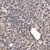 IHC staining of FFPE human liver cancer tissue with TOM1L1 antibody. HIER: boil tissue sections in pH8 EDTA for 20 min and allow to cool before testing.
