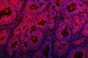Immunofluorescent staining of FFPE human rectal cancer tissue with TOM1L1 antibody (red) and DAPI nuclear stain (blue). HIER: steam section in pH8 EDTA buffer for 20 min.