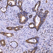 IHC staining of FFPE human colon cancer tissue with TOM1L1 antibody. HIER: boil tissue sections in pH8 EDTA for 20 min and allow to cool before testing.
