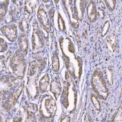 IHC staining of FFPE human prostate adenocarcinoma tissue with TOM1L1 antibody. HIER: boil tissue sections in pH8 EDTA for 20 min and allow to cool before testing.