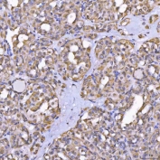 IHC staining of FFPE human thyroid cancer tissue with TOM1L1 antibody. HIER: boil tissue sections in pH8 EDTA for 20 min and allow to cool before testing.
