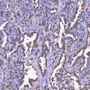 IHC staining of FFPE human lung cancer tissue with TOM1L1 antibody. HIER: boil tissue sections in pH8 EDTA for 20 min and allow to cool before testing.