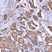 IHC staining of FFPE human breast cancer tissue with TOMM34 antibody. HIER: boil tissue sections in pH8 EDTA for 20 min and allow to cool before testing.