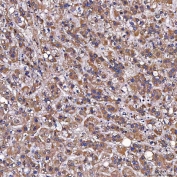 IHC staining of FFPE human liver cancer tissue with TOMM34 antibody. HIER: boil tissue sections in pH8 EDTA for 20 min and allow to cool before testing.