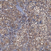 IHC staining of FFPE human cervical cancer tissue with TOMM34 antibody. HIER: boil tissue sections in pH8 EDTA for 20 min and allow to cool before testing.