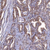 IHC staining of FFPE human prostate cancer tissue with TOMM34 antibody. HIER: boil tissue sections in pH8 EDTA for 20 min and allow to cool before testing.