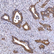 IHC staining of FFPE human colon cancer tissue with TOMM34 antibody. HIER: boil tissue sections in pH8 EDTA for 20 min and allow to cool before testing.