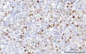 IHC staining of FFPE human testicular seminoma tissue with RRP7A antibody. HIER: boil tissue sections in pH8 EDTA for 20 min and allow to cool before testing.