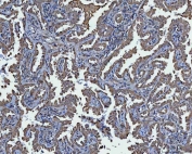 IHC staining of FFPE human lung cancer tissue with TRIM16 antibody. HIER: boil tissue sections in pH8 EDTA for 20 min and allow to cool before testing.