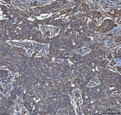 IHC staining of FFPE human ovarian serous adenocarcinoma tissue with TRIM16 antibody. HIER: boil tissue sections in pH8 EDTA for 20 min and allow to cool before testing.