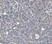 IHC staining of FFPE human liver cancer tissue with TRIM16 antibody. HIER: boil tissue sections in pH8 EDTA for 20 min and allow to cool before testing.