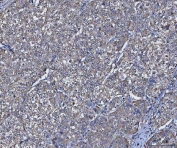 IHC staining of FFPE human cervical cancer tissue with TRIM16 antibody. HIER: boil tissue sections in pH8 EDTA for 20 min and allow to cool before testing.