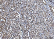 IHC staining of FFPE human prostate cancer tissue with TRIM16 antibody. HIER: boil tissue sections in pH8 EDTA for 20 min and allow to cool before testing.