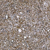 IHC staining of FFPE human liver cancer tissue with SETD3 antibody. HIER: boil tissue sections in pH8 EDTA for 20 min and allow to cool before testing.