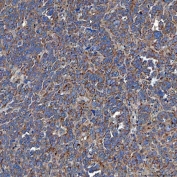 IHC staining of FFPE human ovarian serous cancer tissue with SETD3 antibody. HIER: boil tissue sections in pH8 EDTA for 20 min and allow to cool before testing.