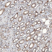 IHC staining of FFPE human renal cancer tissue with SETD3 antibody. HIER: boil tissue sections in pH8 EDTA for 20 min and allow to cool before testing.