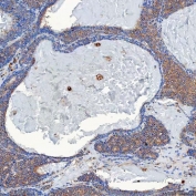 IHC staining of FFPE human breast cancer tissue with SETD3 antibody. HIER: boil tissue sections in pH8 EDTA for 20 min and allow to cool before testing.
