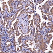 IHC staining of FFPE human lung cancer tissue with TRIM71 antibody. HIER: boil tissue sections in pH8 EDTA for 20 min and allow to cool before testing.