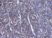 IHC staining of FFPE human prostate adenocarcinoma tissue with TRIM71 antibody. HIER: boil tissue sections in pH8 EDTA for 20 min and allow to cool before testing.