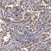 IHC staining of FFPE human lung cancer tissue with TTC7B antibody. HIER: boil tissue sections in pH8 EDTA for 20 min and allow to cool before testing.