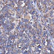 IHC staining of FFPE human ovarian cancer tissue with TTC7B antibody. HIER: boil tissue sections in pH8 EDTA for 20 min and allow to cool before testing.