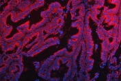 Immunofluorescent staining of FFPE human ovarian cancer tissue with TTC7B antibody (red) and DAPI nuclear stain (blue). HIER: steam section in pH8 EDTA buffer for 20 min.