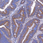 IHC staining of FFPE human colorectal adenocarcinoma tissue with TTC7B antibody. HIER: boil tissue sections in pH8 EDTA for 20 min and allow to cool before testing.