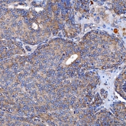 IHC staining of FFPE human breast cancer tissue with TTC7B antibody. HIER: boil tissue sections in pH8 EDTA for 20 min and allow to cool before testing.