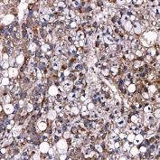 IHC staining of FFPE human liver cancer tissue with TTC7B antibody. HIER: boil tissue sections in pH8 EDTA for 20 min and allow to cool before testing.