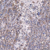 IHC staining of FFPE human laryngeal squamous cell carcinoma tissue with TTC7B antibody. HIER: boil tissue sections in pH8 EDTA for 20 min and allow to cool before testing.