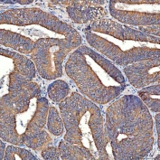 IHC staining of FFPE human endometrial cancer tissue with TTLL2 antibody. HIER: boil tissue sections in pH8 EDTA for 20 min and allow to cool before testing.