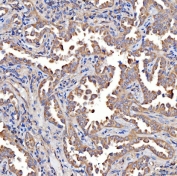 IHC staining of FFPE human lung cancer tissue with TTLL2 antibody. HIER: boil tissue sections in pH8 EDTA for 20 min and allow to cool before testing.