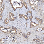 IHC staining of FFPE human colon cancer tissue with TTLL2 antibody. HIER: boil tissue sections in pH8 EDTA for 20 min and allow to cool before testing.