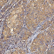 IHC staining of FFPE human cervical cancer tissue with TTLL2 antibody. HIER: boil tissue sections in pH8 EDTA for 20 min and allow to cool before testing.