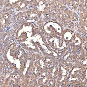 IHC staining of FFPE human thyroid cancer tissue with TTLL2 antibody. HIER: boil tissue sections in pH8 EDTA for 20 min and allow to cool before testing.