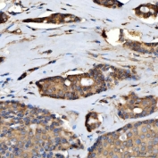 IHC staining of FFPE human breast cancer tissue with TTLL2 antibody. HIER: boil tissue sections in pH8 EDTA for 20 min and allow to cool before testing.