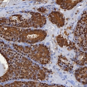 IHC staining of FFPE human breast cancer tissue with Selenium Binding Protein antibody. HIER: boil tissue sections in pH8 EDTA for 20 min and allow to cool before testing.
