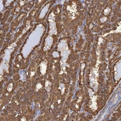 IHC staining of FFPE human thyroid cancer tissue with Selenium Binding Protein antibody. HIER: boil tissue sections in pH8 EDTA for 20 min and allow to cool before testing.