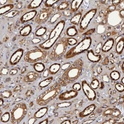IHC staining of FFPE human renal cancer tissue with Selenium Binding Protein antibody. HIER: boil tissue sections in pH8 EDTA for 20 min and allow to cool before testing.