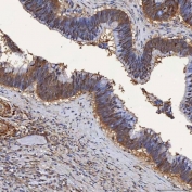 IHC staining of FFPE human colon adenocarcinoma tissue with Selenium Binding Protein antibody. HIER: boil tissue sections in pH8 EDTA for 20 min and allow to cool before testing.