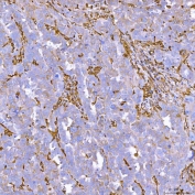 IHC staining of FFPE human ovarian serous cancer tissue with Semaphorin-4F antibody. HIER: boil tissue sections in pH8 EDTA for 20 min and allow to cool before testing.