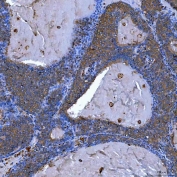 IHC staining of FFPE human breast cancer tissue with Semaphorin-4F antibody. HIER: boil tissue sections in pH8 EDTA for 20 min and allow to cool before testing.