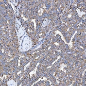 IHC staining of FFPE human thyroid cancer tissue with Semaphorin-4F antibody. HIER: boil tissue sections in pH8 EDTA for 20 min and allow to cool before testing.