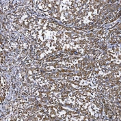 IHC staining of FFPE human lung adenocarcinoma tissue with Semaphorin-4F antibody. HIER: boil tissue sections in pH8 EDTA for 20 min and allow to cool before testing.