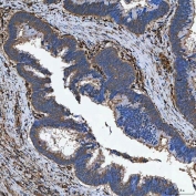 IHC staining of FFPE human colon adenocarcinoma tissue with Semaphorin-4F antibody. HIER: boil tissue sections in pH8 EDTA for 20 min and allow to cool before testing.